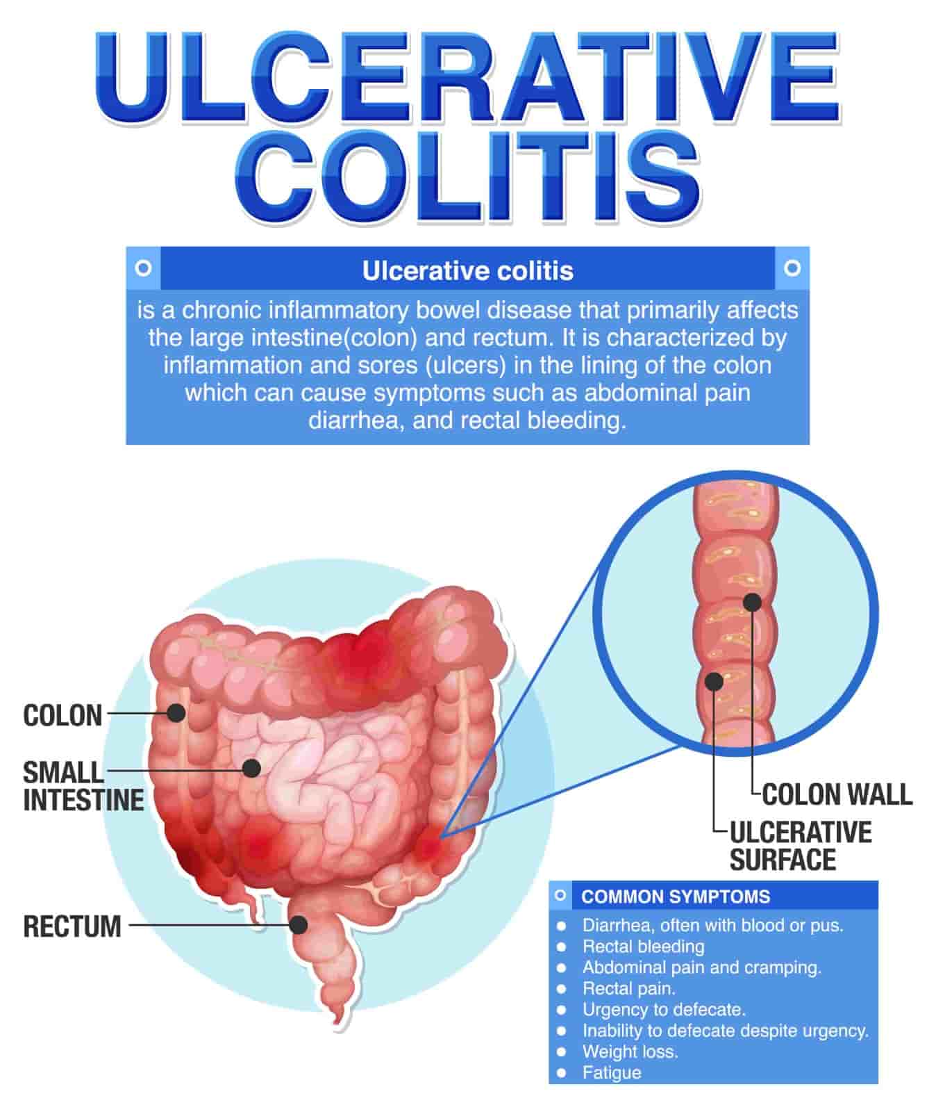 colitis treatment in indore