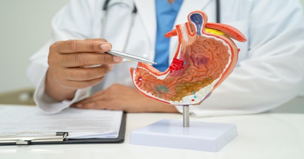 colon cancer treatment in indore,Best colon cancer treatment in indore,